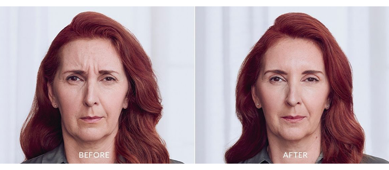 Botox before and After