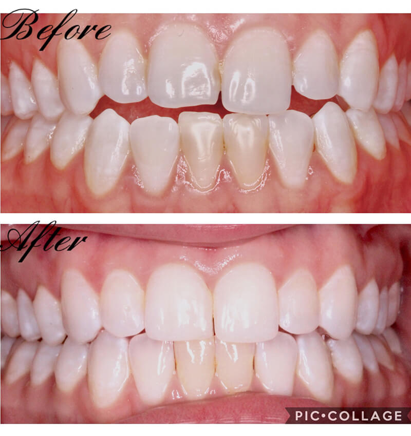 INVISALIGN before and after4