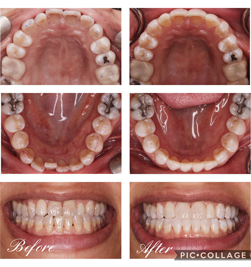 INVISALIGN before and after4