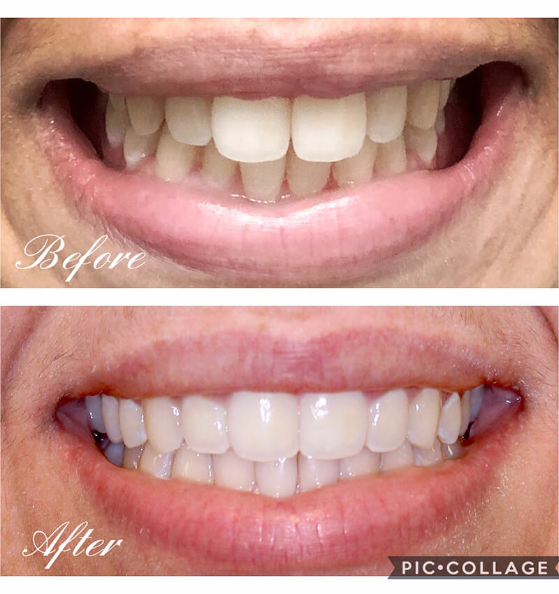 INVISALIGN before and after4