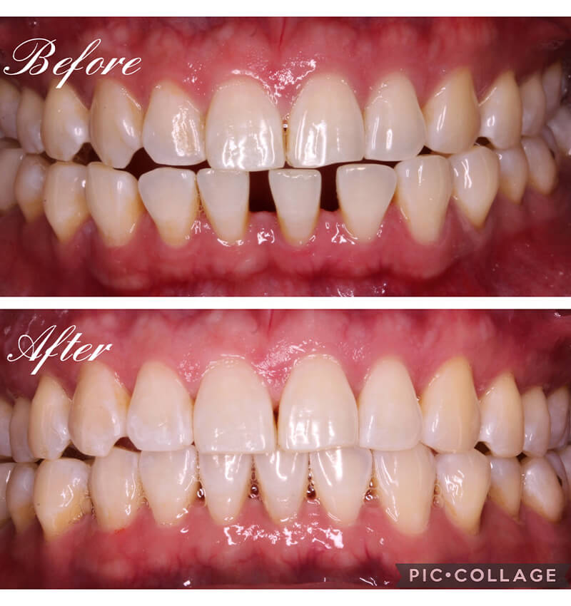INVISALIGN before and after4