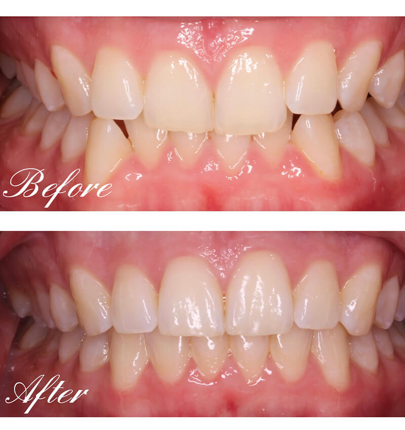 INVISALIGN before and after4