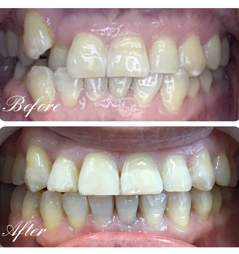 INVISALIGN before and after4