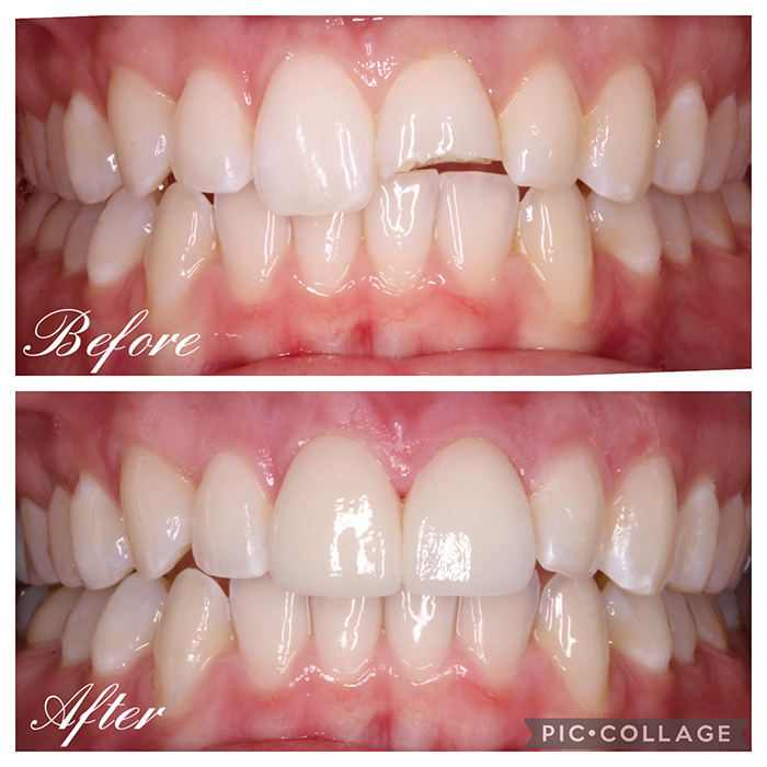 Porcelain Veneers Before and after-2