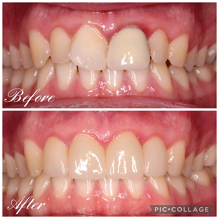 Porcelain Veneers Before and after-2