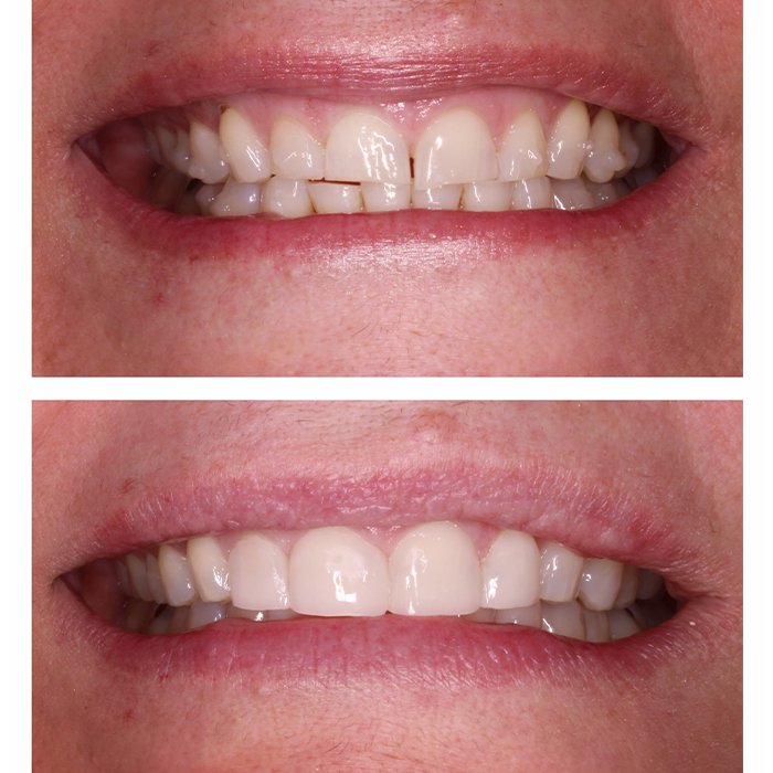 Porcelain Veneers Before and after-2